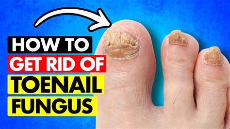 reddit nail fungus|will monistat cure toe fungus.